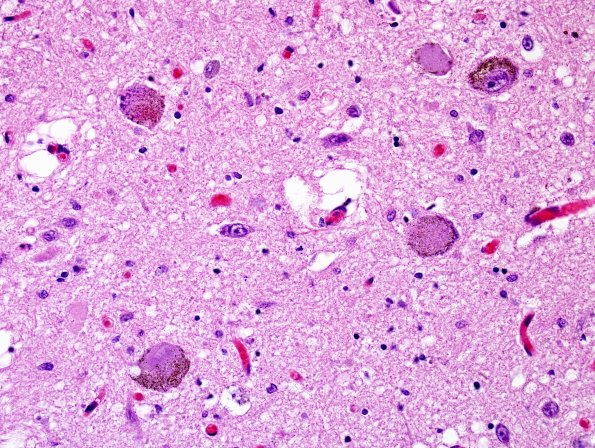 13B3 PSP (Case 13) N7 LC H&E 1.jpg