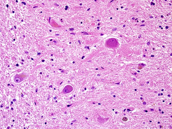 13B4 PSP (Case 13) N9 dentate grumose H&E 1.jpg