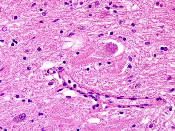 13B5 PSP (Case 13) N9 dentate grumose H&E 6.jpg