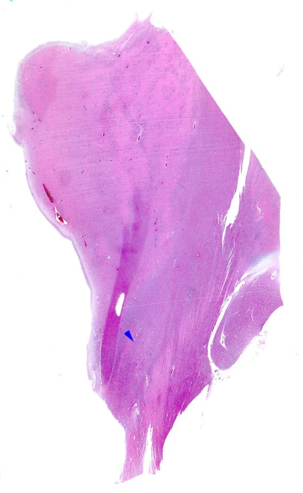 14B2 PSP (Case 14) N4 H&E WM copy