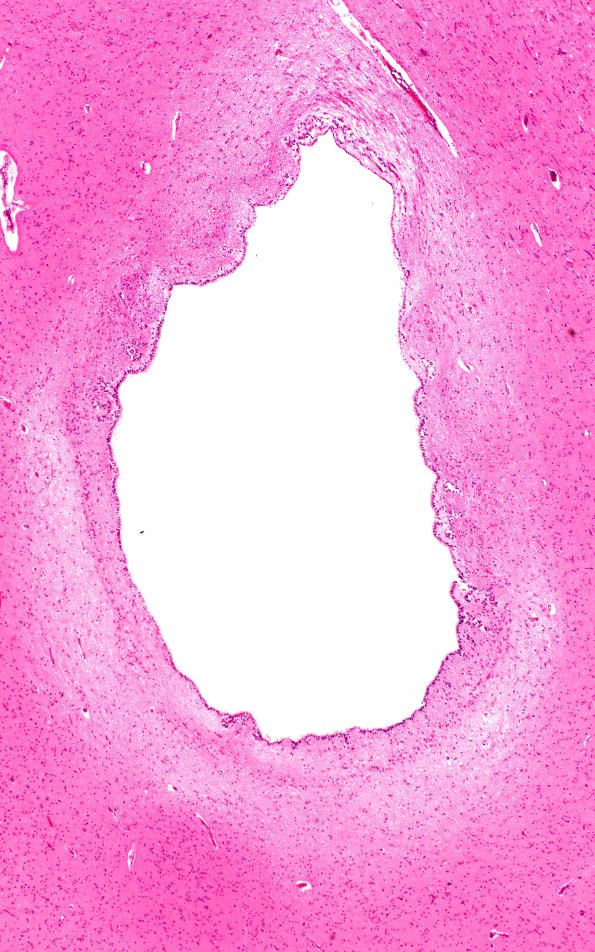 14B5 PSP (Case 14) N6 PAG 4X 2