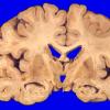 15A1 Progressive Supranuclear Palsy (Case 15) 2