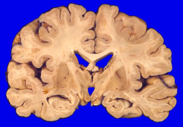 15A1 Progressive Supranuclear Palsy (Case 15) 2