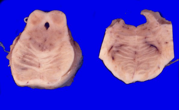 15A2 Progressive Supranuclear Palsy (Case 15) 4
