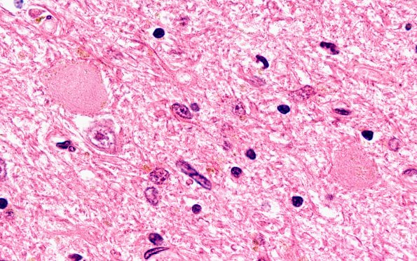 15B5 PSP (Case 15) 2 H&E STN 100X