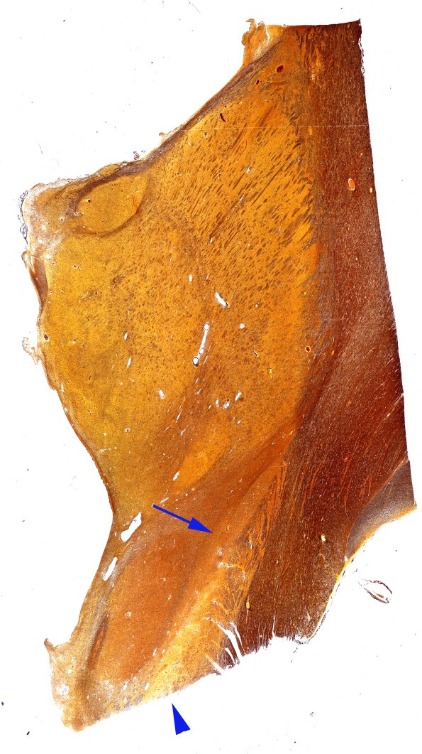 15C1 PSP (Case 15) 2 WM Biels copy