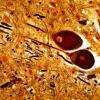 15C5 PSP (Case 15) V nerve Biels