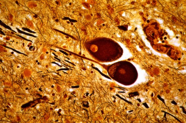 15C5 PSP (Case 15) V nerve Biels