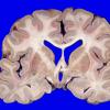 16A1 Progressive Supranuclear Palsy (Case 16) 1