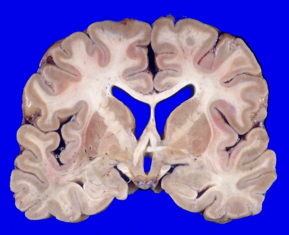 16A1 Progressive Supranuclear Palsy (Case 16) 1