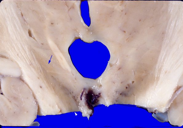 16A2 Progressive Supranuclear Palsy (Case 16) 2 copy copy