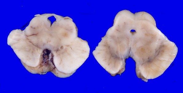 16A3 Progressive Supranuclear Palsy (Case 16) 3