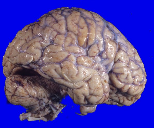 17A1 Progressive Supranuclear Palsy (PSP) (Case 17) 1