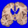 17A2 Progressive Supranuclear Palsy (PSP) (Case 17) 3