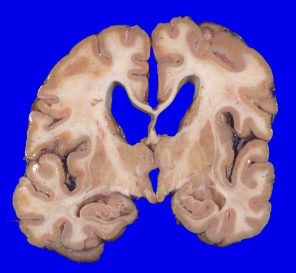 17A2 Progressive Supranuclear Palsy (PSP) (Case 17) 3