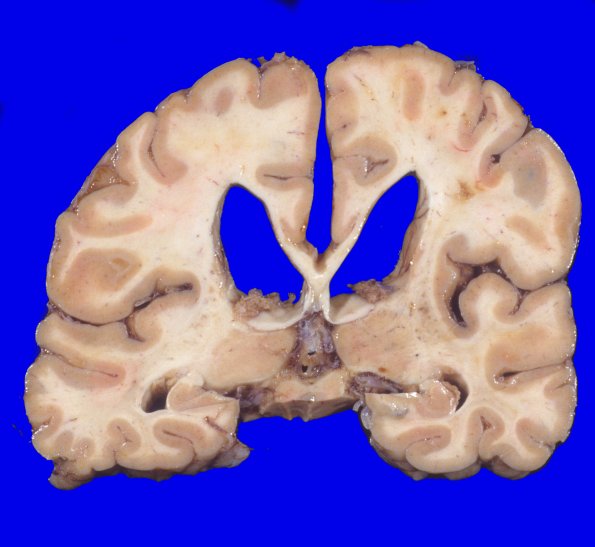 17A3 Progressive Supranuclear Palsy (PSP) (Case 17) 4