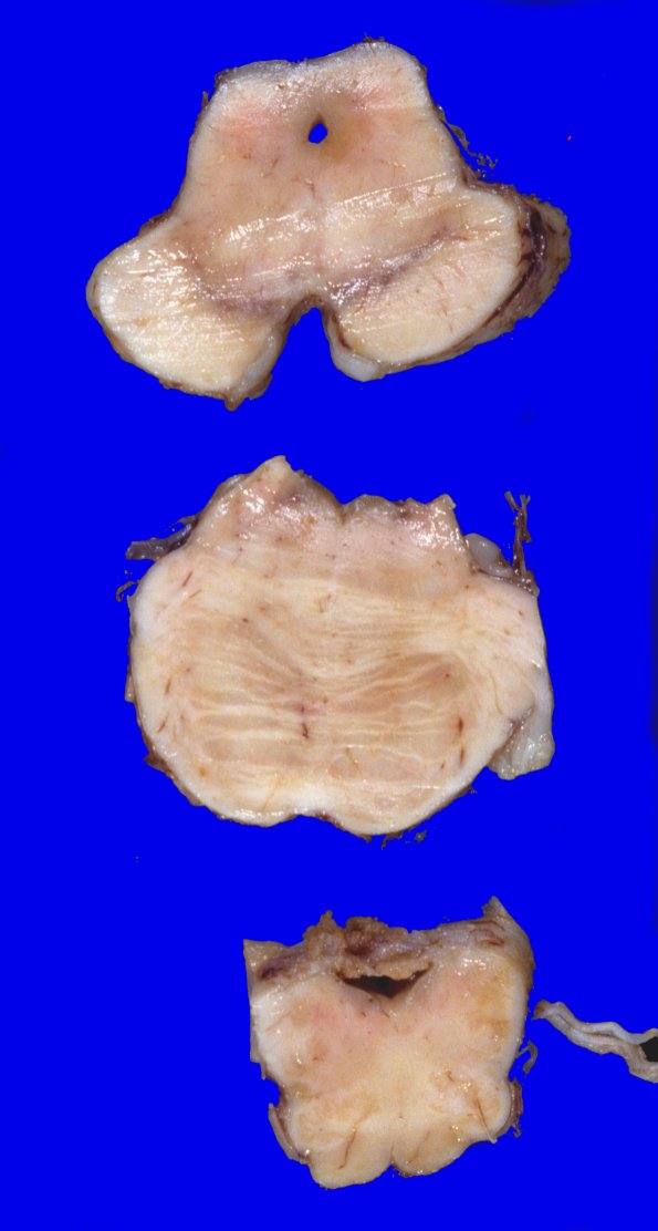 17A4 Progressive Supranuclear Palsy (PSP) (Case 17) 2