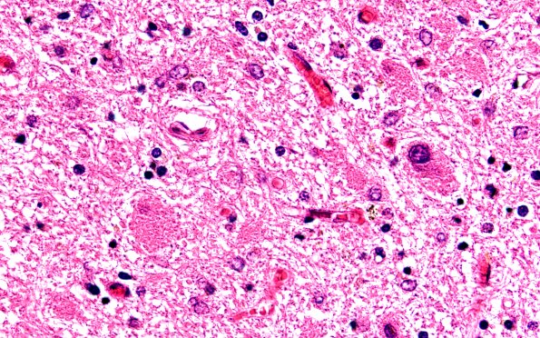 17B10 Progressive Supranuclear Palsy (PSP) (Case 17) N9 Dentate H&E 60X 3