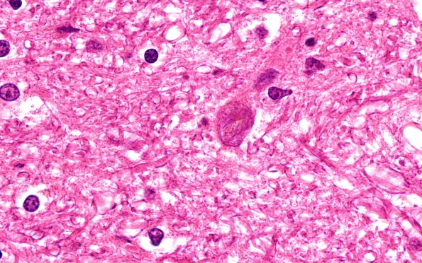 17B2 Progressive Supranuclear Palsy (PSP) (Case 17) STN H&E 100X 1