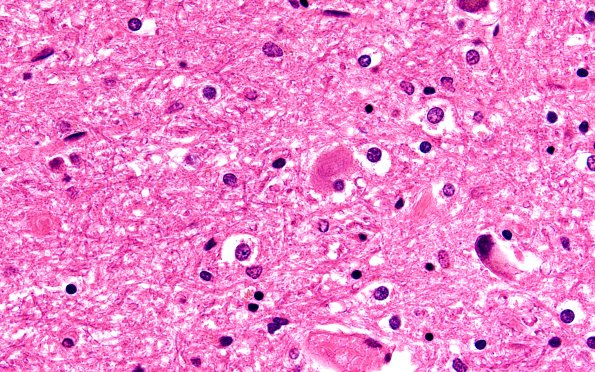 17B3 Progressive Supranuclear Palsy (PSP) (Case 17) STN H&E 100X 2