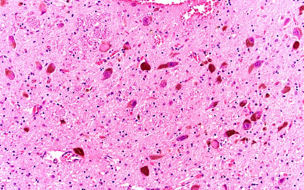 17B4 Progressive Supranuclear Palsy (PSP) (Case 17) N6 SN H&E 20X 2