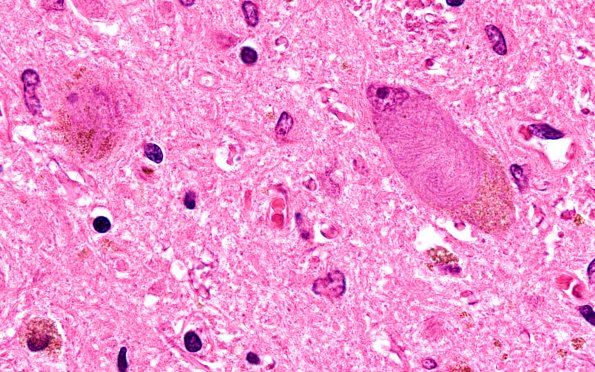 17B6 Progressive Supranuclear Palsy (PSP) (Case 17) N6 SN H&E 100X 2
