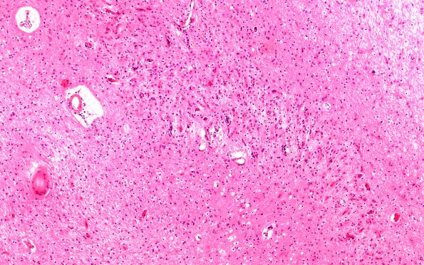 17B8 Progressive Supranuclear Palsy (PSP) (Case 17) N9 Dentate H&E 10X