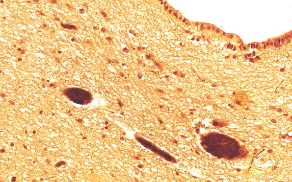 17C1 Progressive Supranuclear Palsy (PSP) (Case 17) N6 PAG Biels 40X 2