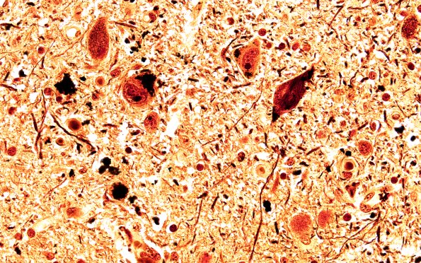 17C2 Progressive Supranuclear Palsy (PSP) (Case 17) N6 SN Biels 60X 1