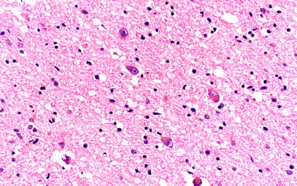 18A2 (Case 18) H&E Subthal 40X 2