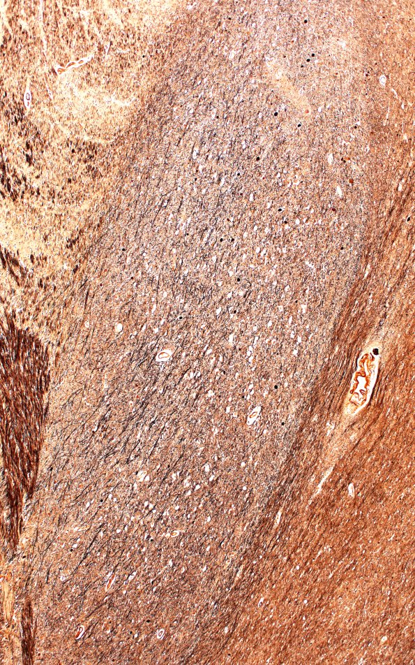 18B3 (Case 18) Biels Subthal 4XA