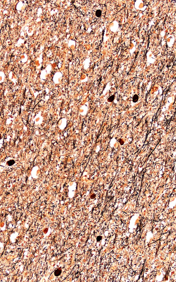 18B4 (Case 18) Biels Subthal 20X 2