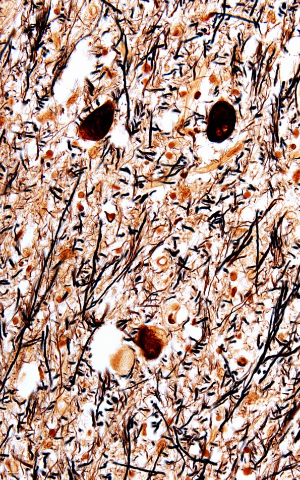 18B5 (Case 18) Biels Subthal 60X 2