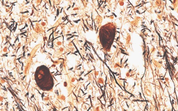 18B6 (Case 18) Biels Subthal Biels 100X