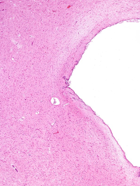 1B3 PSP (Case 1) N6 H&E Tectum & PAG.jpg