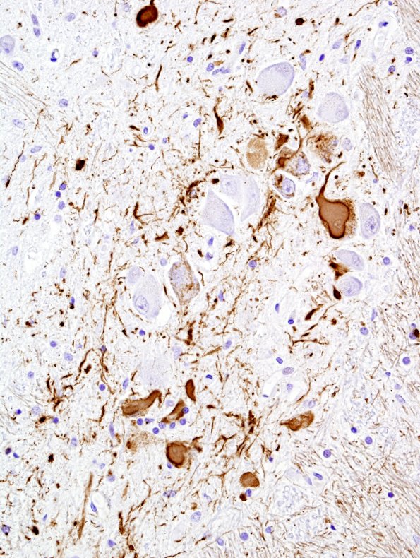 1C18 PSP (Case 1) N7 Medulla PHF1 3.jpg