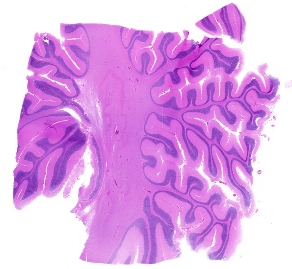 2B1 PSP (Case 2), dentate 8