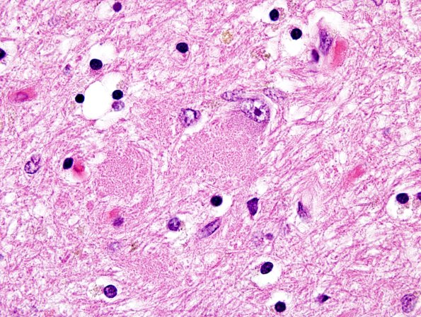 3A8 PSP (Case 3) Dentate Nucleus H&E 22A