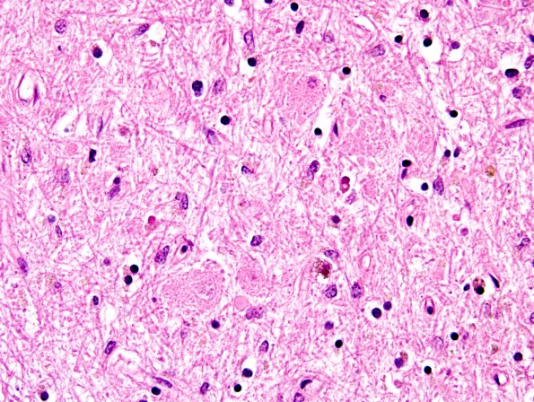 3A9 PSP (Case 3) Dentate Nucleus H&E 14