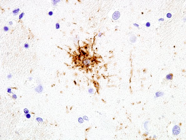 3B2 PSP (Case 3) (tufted astrocyte) Caudate PHF