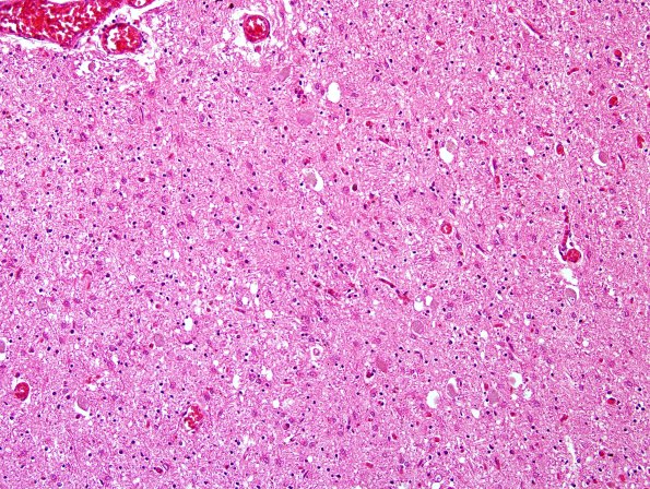 4B1 PSP (Case 4) subthalamus PHF1 1.jpg