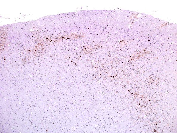 4C1 PSP (Case 4) parahippocampal gyrus PHF1 2.jpg