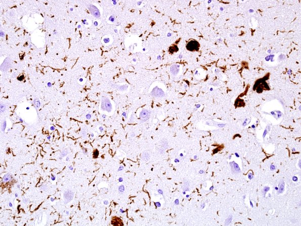 4C2 PSP (Case 4) parahippocampal gyrus PHF1 4.jpg