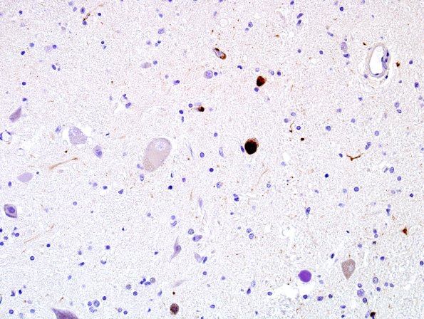 4C8 PSP (Case 4) L13 spinal cord H&E.jpg