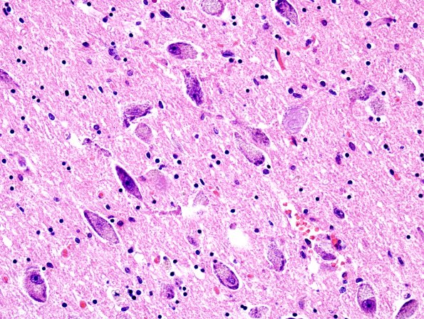 5B3 PSP (Case 5) nBM H&E 1