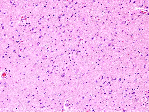 5B4 PSP (Case 5) Hypothalamus H&E 2