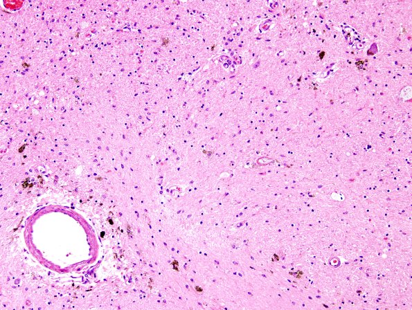 5B5 PSP (Case 5) Substantia Nigra H&E 6