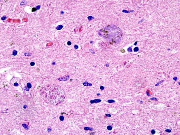 5B6 PSP (Case 5) Substantia Nigra H&E 10