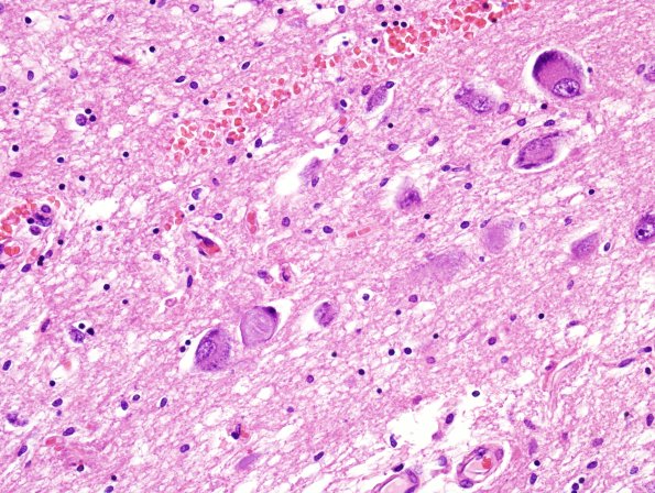 5B7 PSP (Case 5) Oculomotor nucleus H&E