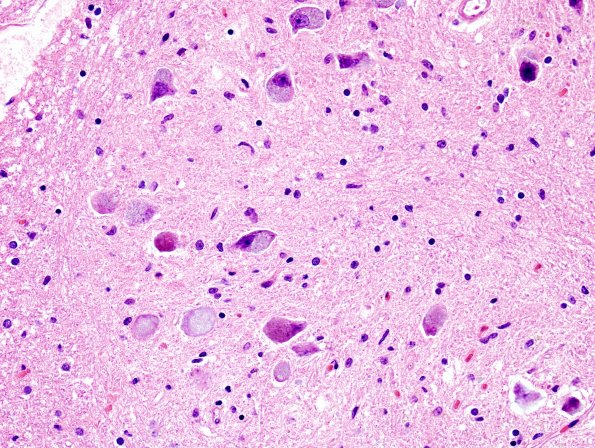 5B9 PSP (Case 5) ION H&E 9